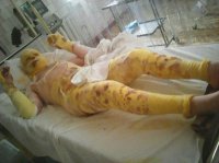 Французские СМИ: «Пушечное мясо» Порошенко на грани исчезновения