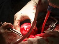 Облегчат ли жизнь черным трансплантологам на Украине?