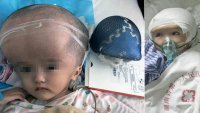 В Китае трехлетней девочке пересадили череп, напечатанный на 3D-принтере