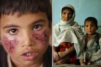 ДАИШ распространяет в Сирии болезнь, разъедающую плоть