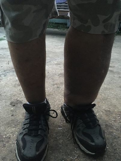 Наследие BP: разлив нефти в Мексиканском заливе породил бактерию-убийцу Наследие BP: разлив нефти в Мексиканском заливе породил бактерию-убийцу