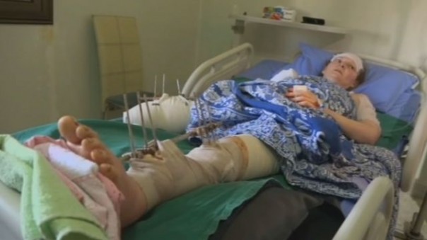 Россиянка в Сирии потеряла кисть руки и ногу, спасая детей от мины Россиянка в Сирии потеряла кисть руки и ногу, спасая детей от мины