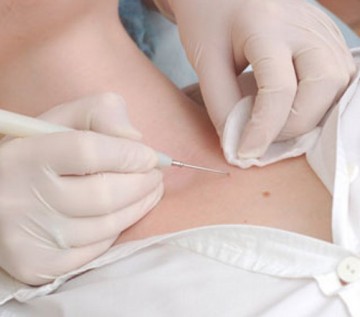 Лечение бородавок и папиллом