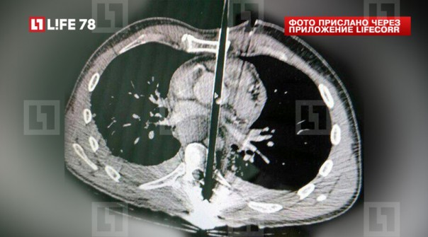 В Петербурге врачи спасли мужчину с двумя стрелами в сердце В Петербурге врачи спасли мужчину с двумя стрелами в сердце