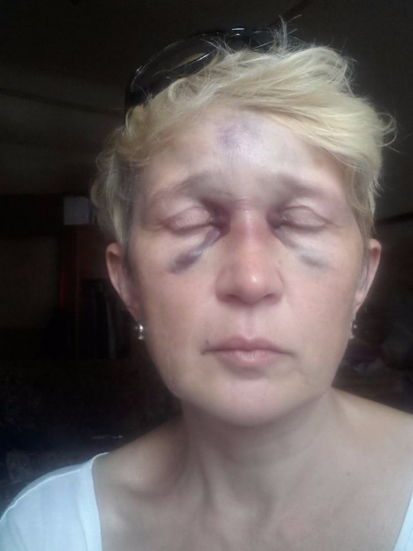 Цивилизованная Цэевропа: в Одессе избита известная журналистка Цивилизованная Цэевропа: в Одессе избита известная журналистка