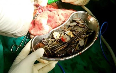 В Индии врачи извлекли из пациента семь килограммов железа и камней