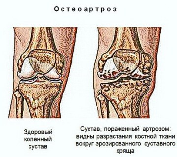 А.В.Росич. Как надежно притормозить развитие артроза?