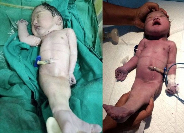 В Индии родился "ребенок-русалка"