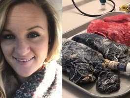 Лёгкие здорового человека vs лёгкие курильщика: медсестра выложила ужасное видео