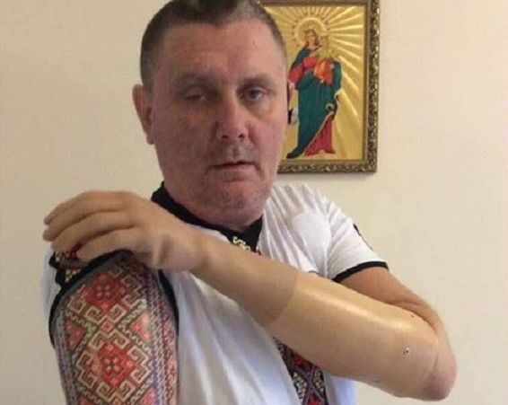 АТОшников–инвалидов «награждают» протезами–вышиванками
