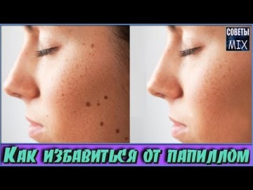 Как избавиться от папиллом в домашних условиях очень простым способом. Рецепты здоровья