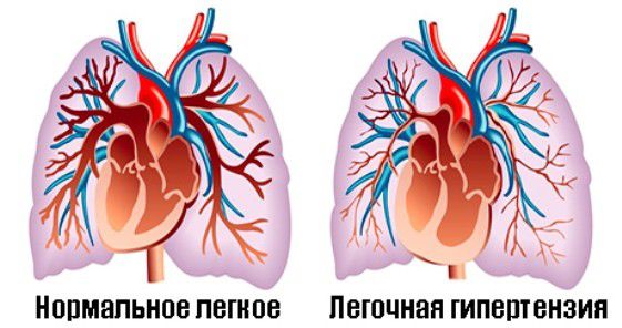 Причины и лечение легочной гипертензии
