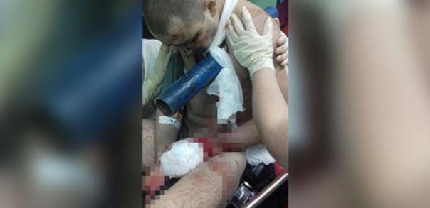 Белорусский Халк 2.0. В Норильске металлическая труба пробила плечо мужчине