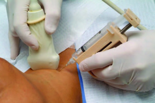 Биопсия - один из способов выявления рака