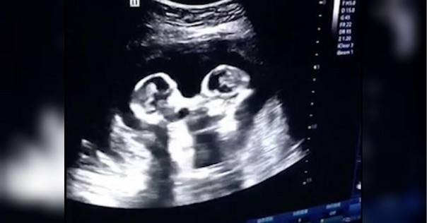 «Драку» близнецов в утробе матери во время УЗИ сняли на видео