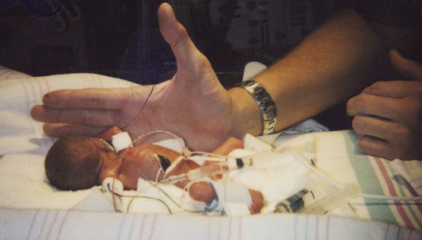 Размером с яблоко: в США родился самый маленький ребенок