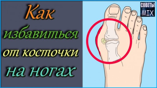 Как избавиться от косточки на большом пальце. 3 эффективных способа народной медицины