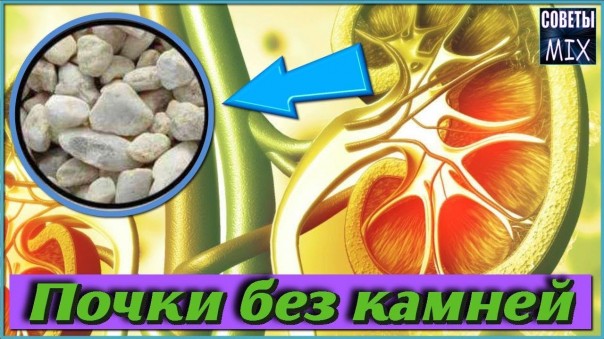 Как не допустить образования камней в почках. Топ 5 проверенных способа. Полезные советы для здоровья