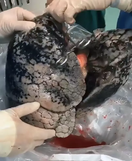 Врачи показали, как выглядят лёгкие после 30 лет курения — видео 18+