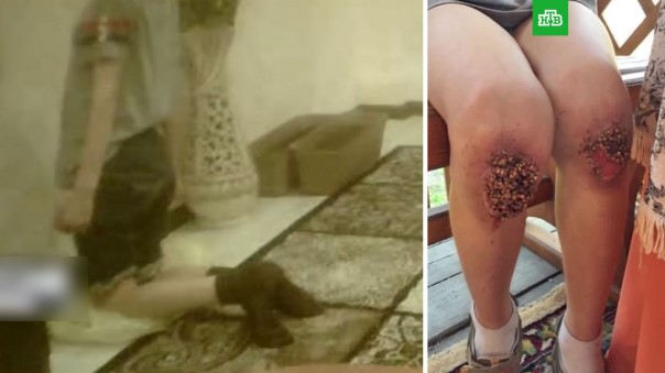 В Омске мальчику из-за пыток в семье в ноги вросла гречка