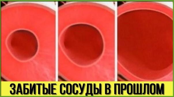 Забитые сосуды теперь в прошлом: Как предотвратить образование тромбов в сосудах