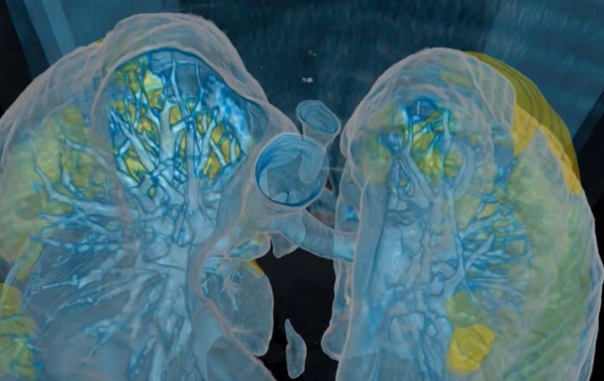 Как вирус COVID-19 поражает легкие показали на видео