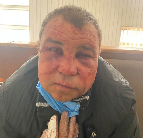 Был похож на бомжа. Врачи в Киеве отказались помочь избитому херою АТЫ