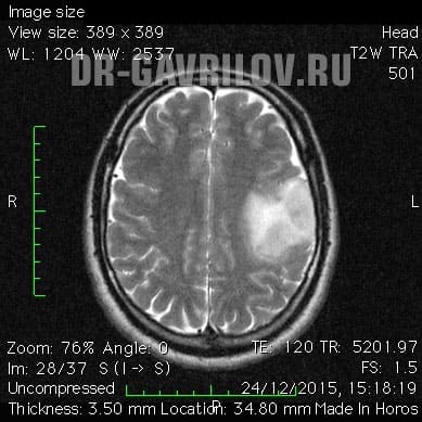 Фибриллярная астроцитома головного мозга