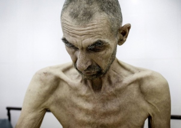 Немецкие СМИ: на волне эпидемии коронавируса на Украину вернулась «белая чума» - туберкулёз