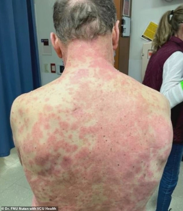 У мужчины после вакцинации Johnson & Johnson облезла кожа