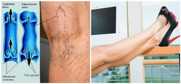 Как лечить варикозное расширение вен