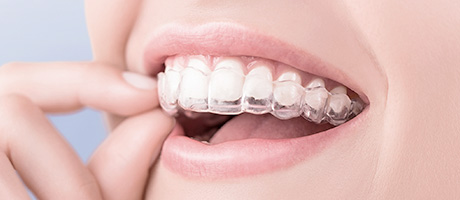 Керамические или металлические брекеты – что выбрать?
