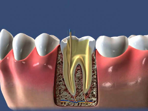 Периодонтит: что собой представляет и какие виды заболевания бывают