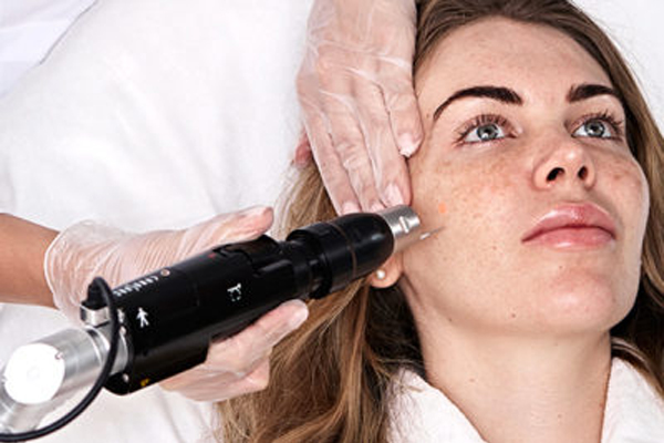 Преимущества лечения пигментации лазером
