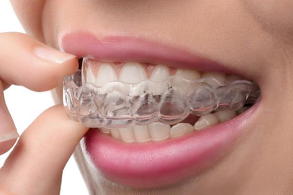 Элайнеры: современное решение для идеальной улыбки