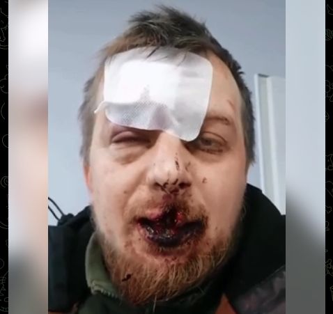 Пытались убить за «гроши на ВСУ»: волонтёра жестоко избили молотками и кастетами