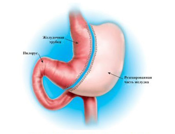 Эндоскопическая рукавная гастропластика: современный метод снижения веса без разрезов