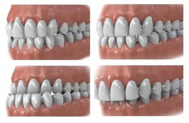 Аномалии прикуса и развития челюстей: причины, диагностика и современные методы лечения
