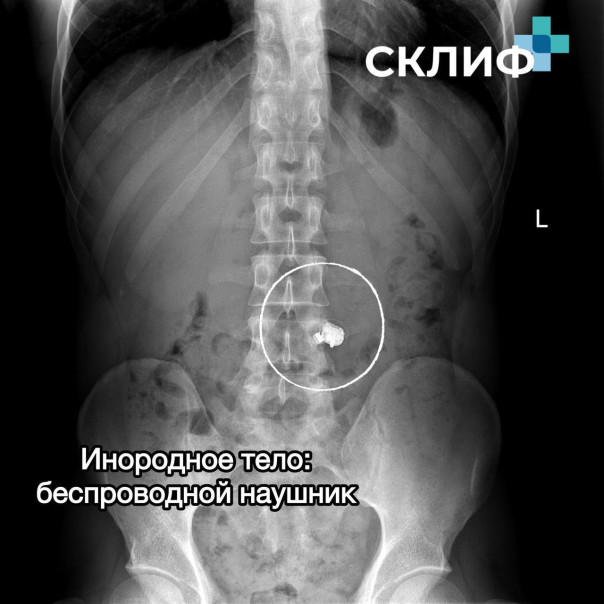 НИИ им. Склифосовского опубликовал самые интересные находки в пациентах